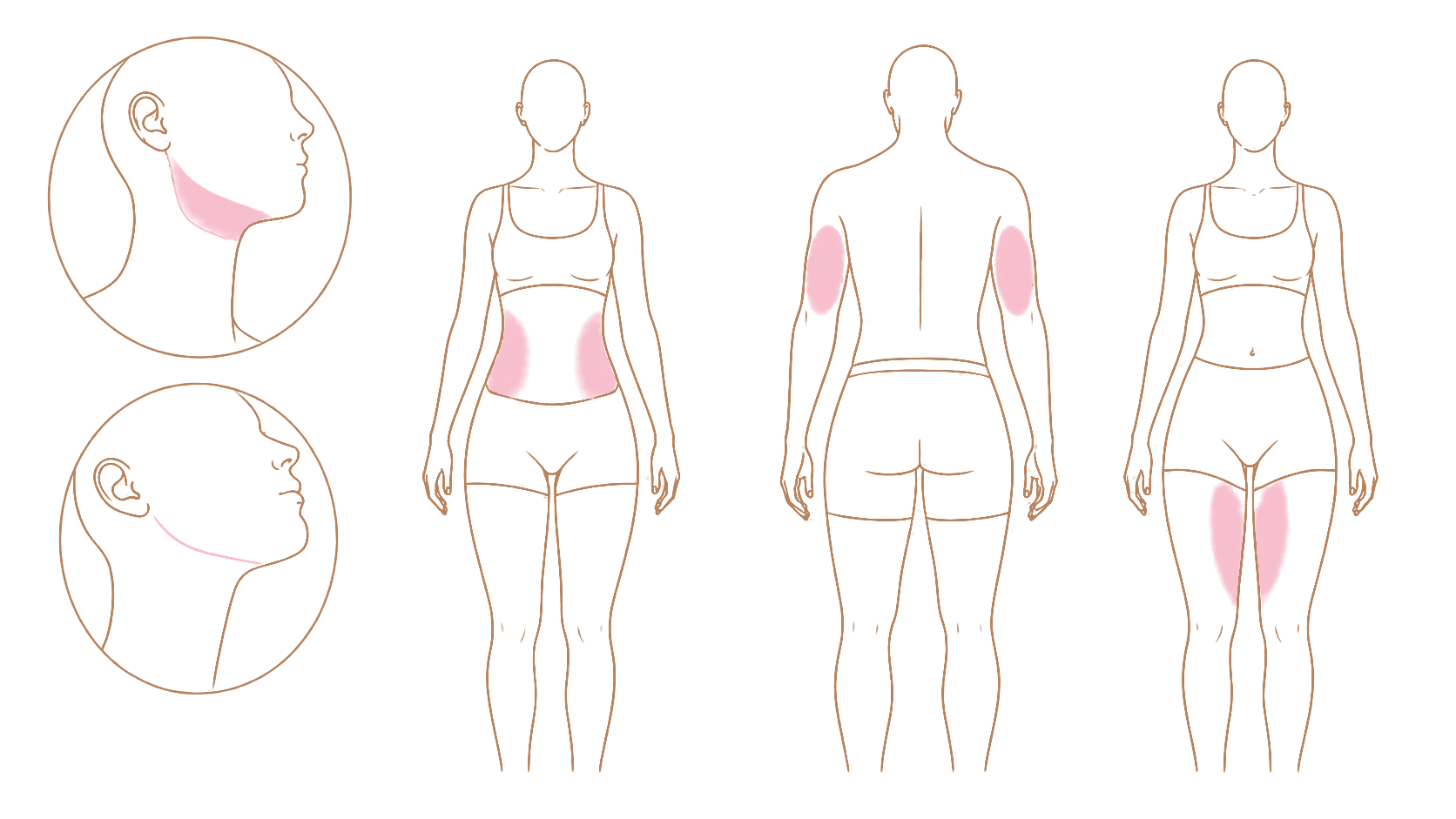 Zones de traitement en cours d'évaluation : tiers inférieur du visage et cou, bras, abdomen et flancs, et face médiale des cuisses